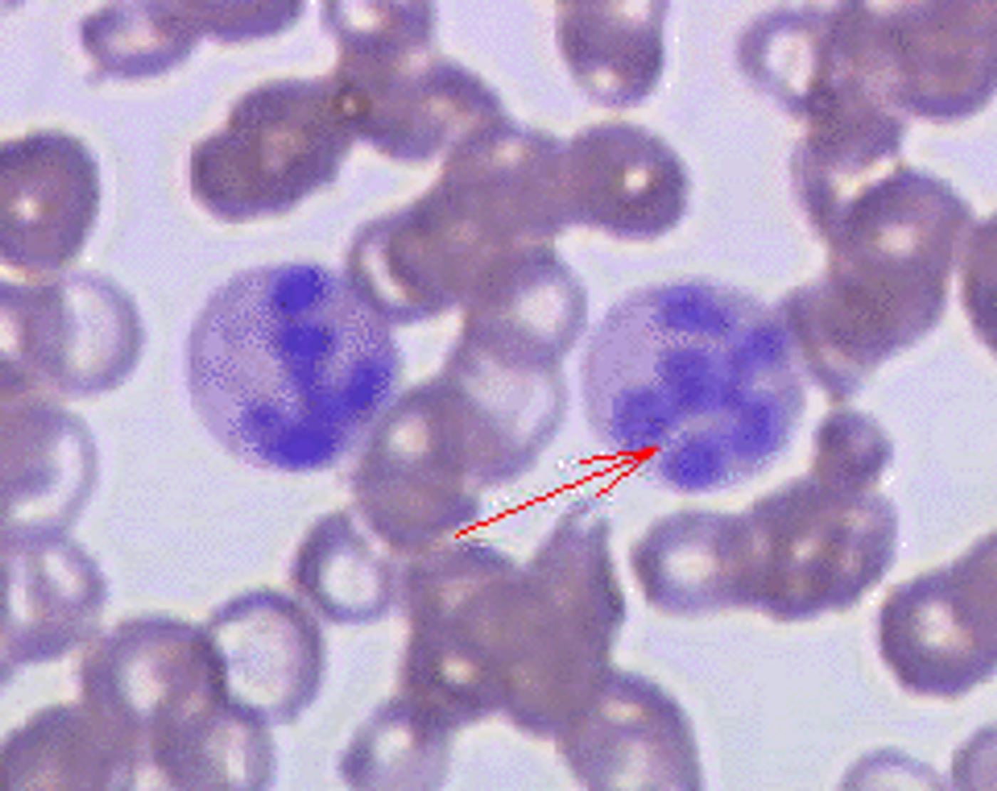 周邊血抹片近拍，可見一顆 neutrophil 的細胞核分成超過五葉